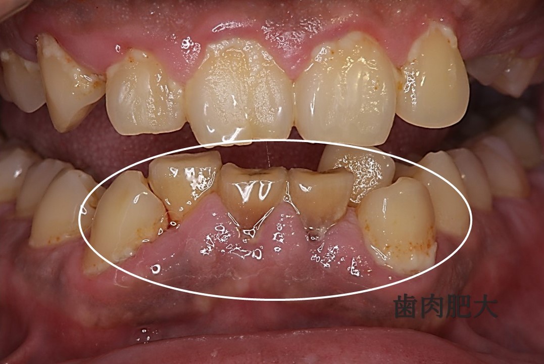 歯茎の輪郭形成には何が含まれますか?