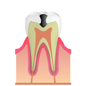 C2：細菌が象牙質に到達した虫歯