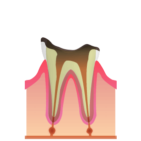 C4: 細菌が歯の根元に到達した末期の虫歯